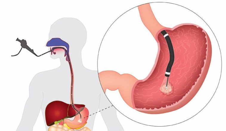 γαστροσκοπηση